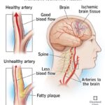 transient cerebral ischemia