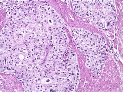 transitional cell carcinoma of the urinary tract