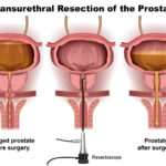 transurethral prostatectomy infection prevention