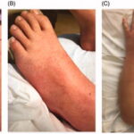 traumatic skin lesion streptococcus pyogenes infection