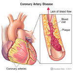 treatment to slow progression of coronary artery disease