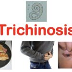 trichinosis