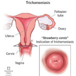 trichomoniasis