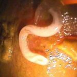 trichuriasis
