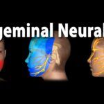 trigeminal neuralgia