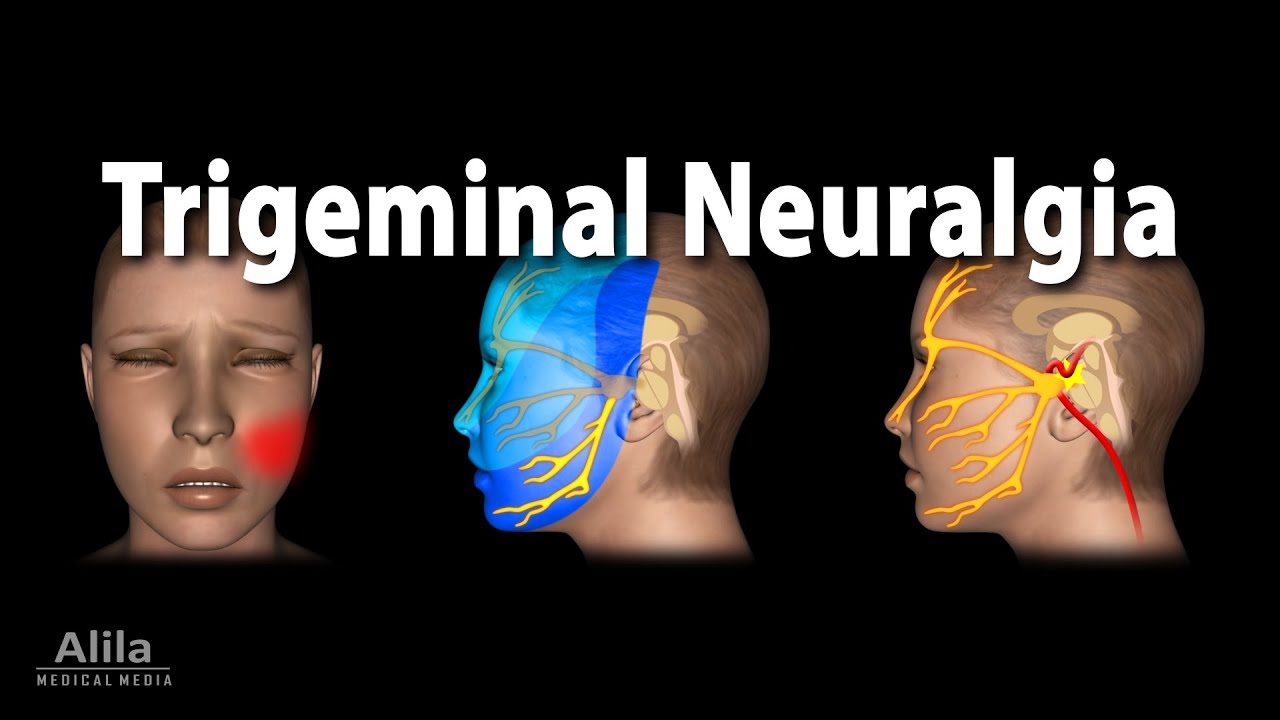 trigeminal neuralgia