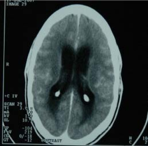 tuberculosis meningitis