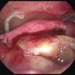 tubo-ovarian abscess