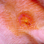 tularemia