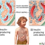 type 1 diabetes mellitus