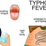 typhoid fever