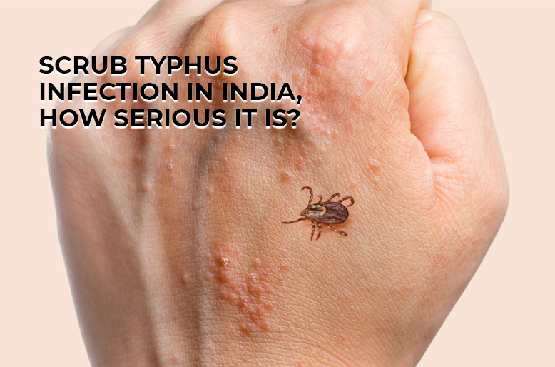 typhus infections