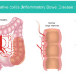 ulcerative colitis