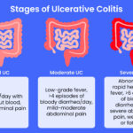 ulcerative colitis remission