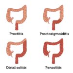 ulcerative proctitis