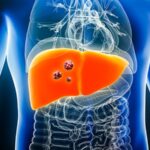 unresectable hepatic metastatic uveal melanoma