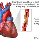 unstable angina pectoris
