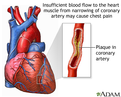 unstable angina pectoris