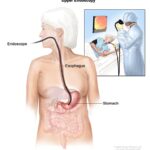 upper gi bleed