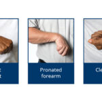 upper limb spasticity