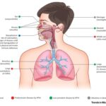 upper respiratory infection due to haemophilus influenzae