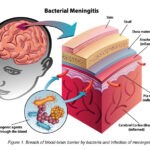 upper respiratory infection due to neisseria meningitidis