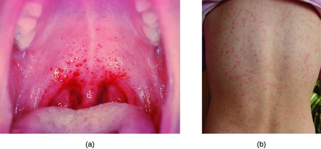 upper respiratory streptococcal infection