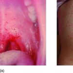 upper respiratory streptococcal infection