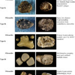 urate renal calculi