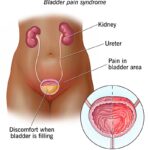 ureteral spasm with pain