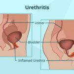urethritis