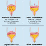 urinary incontinence