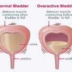 urinary incontinence due to detrusor overactivity