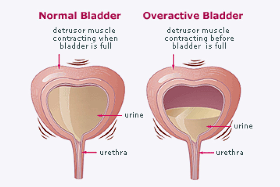 urinary incontinence due to detrusor overactivity