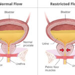urinary retention