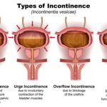 urinary urge incontinence