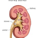 urolithiasis