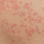 urticaria causes
