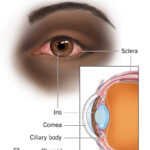 uveitis