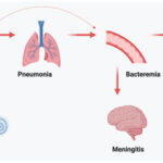 vaccination to prevent otitis media due to streptococcus pneumoniae