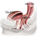 vaginal cuff surgery post-op bacteroides infection