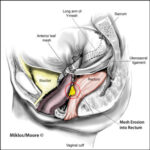 vaginal cuff surgery post-op infection