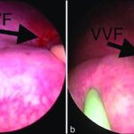 vaginal cuff surgery post-op peptococcus infection