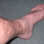 varicose veins