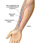 vascular access thrombosis