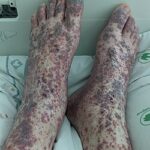 vasculitis