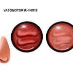 vasomotor rhinitis