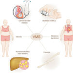 vasomotor symptoms associated with menopause