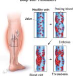 venous thrombosis