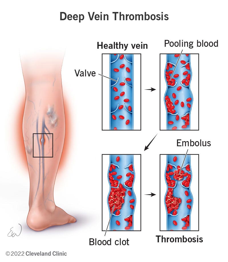venous thrombosis